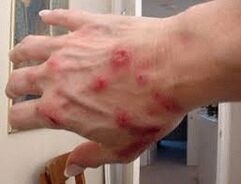 Papules στο δέρμα με helminthiasis